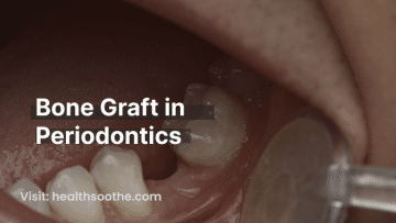 Bone Graft in Periodontics