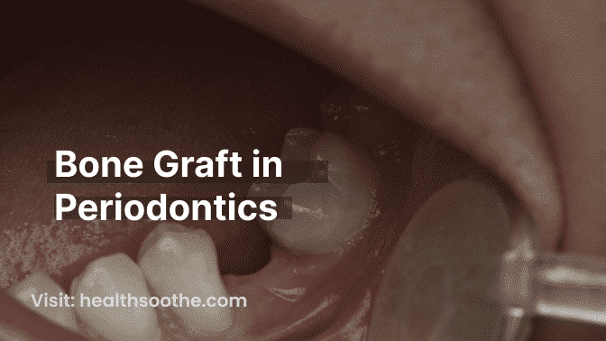 Bone Graft In Periodontics