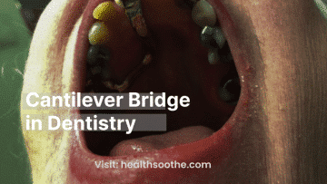 Cantilever Bridge In Dentistry