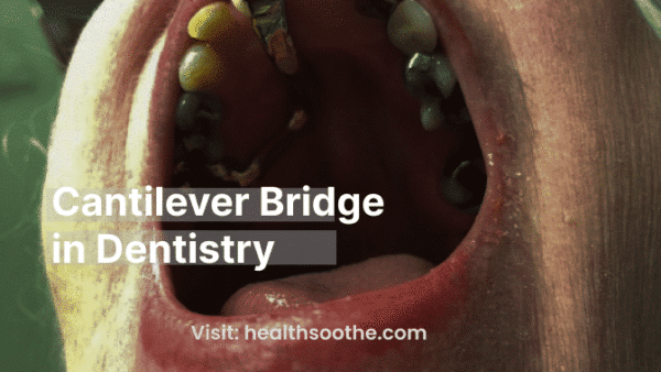 What Is A Cantilever Bridge In Dentistry