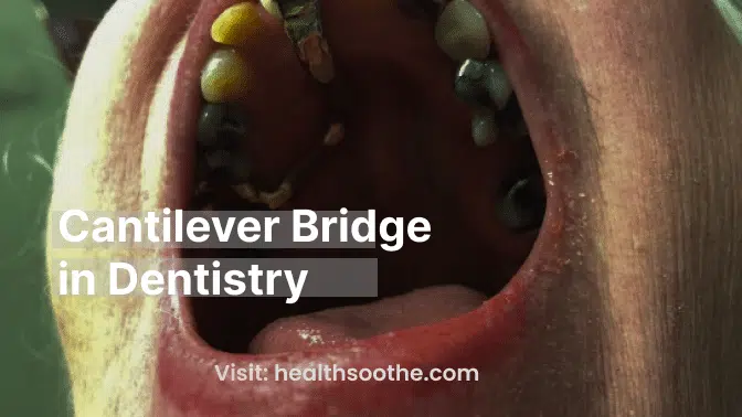 Cantilever Bridge in Dentistry