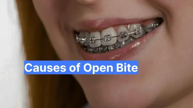 Causes of Open Bite