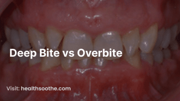 Deep Bite Vs Overbite
