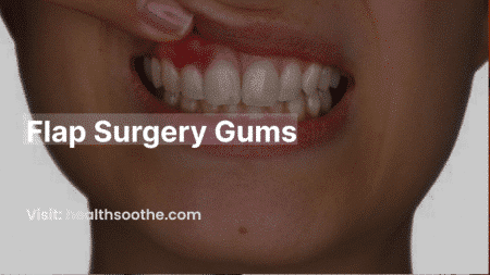 Flap Surgery Gums