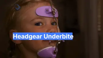 Headgear Underbite