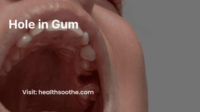 Hole In Gum