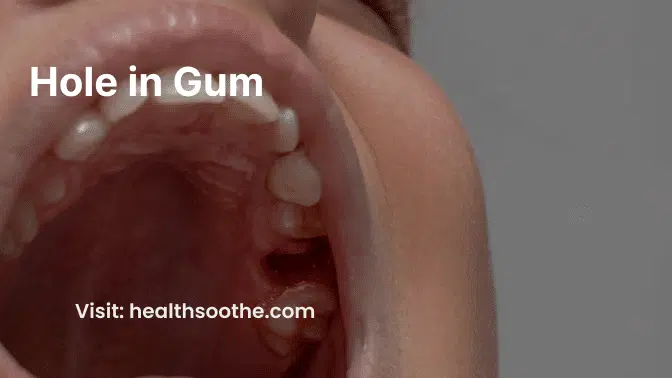 Hole in Gum