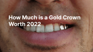 How Much is a Gold Crown Worth 2022