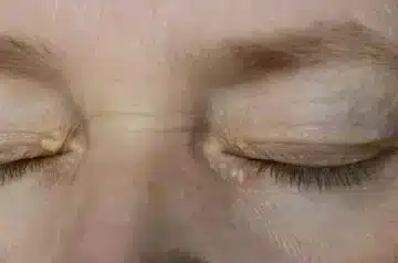 Xanthelasma: Causes, Types, Symptom & Treatments | ClearSkin, Pune