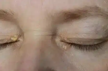 Xanthelasma: Causes, Types, Symptom & Treatments | ClearSkin, Pune