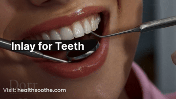Inlay for Teeth