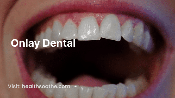Onlay Dental