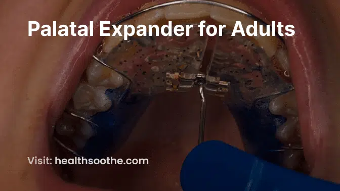Palatal Expander for Adults