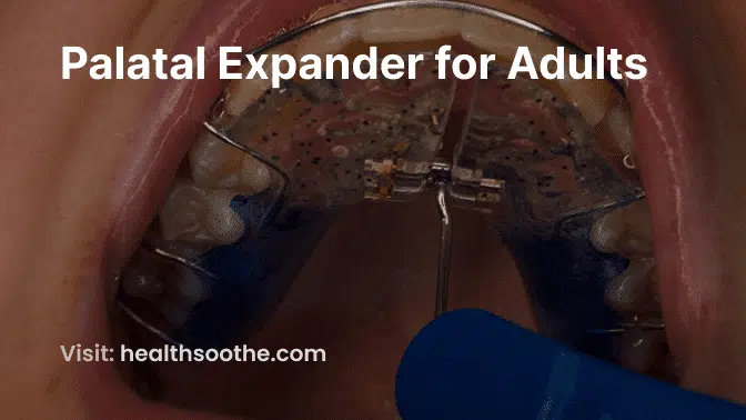 Palatal Expander for Adults