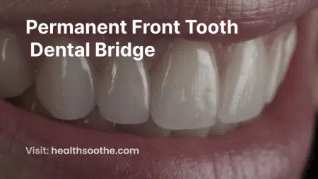 Permanent Front Tooth Dental Bridge