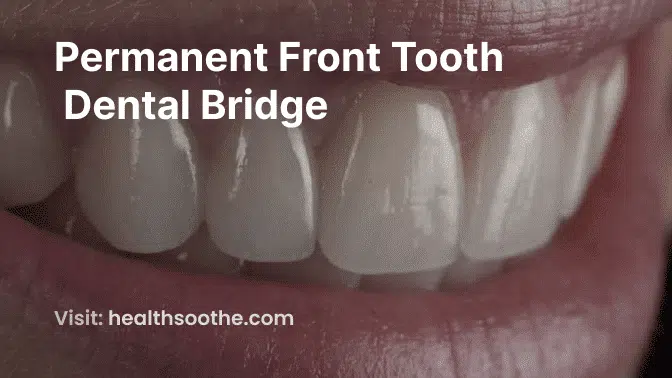 Permanent Front Tooth Dental Bridge