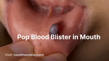 Pop Blood Blister in Mouth