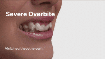 Severe Overbite