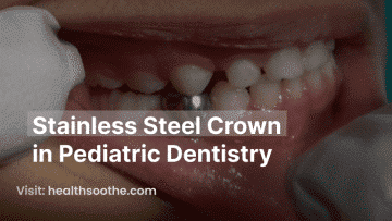 Stainless Steel Crown In Pediatric Dentistry