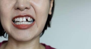 The Health Consequences Of Missing Teeth