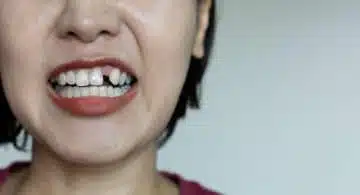 The Health Consequences Of Missing Teeth