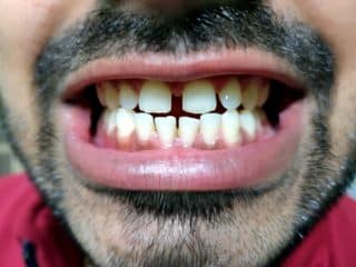 The Hidden Dangers Of Teeth Gaps