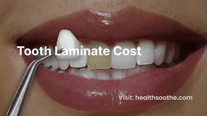 Tooth Laminate Cost