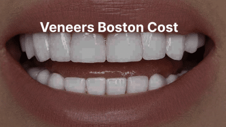 Veneers Boston Cost