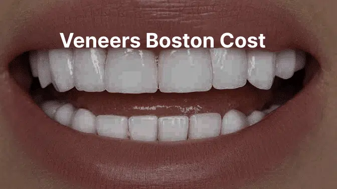 Veneers Boston Cost