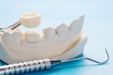 Dental Veneers vs. Crowns: Which One Should You Get?