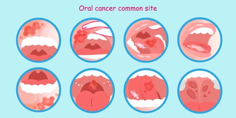 Everything You Need To Know About Oral Cancer Screening