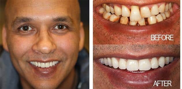 Smile Makeover Procedures – Solution To A Questionable Smiles