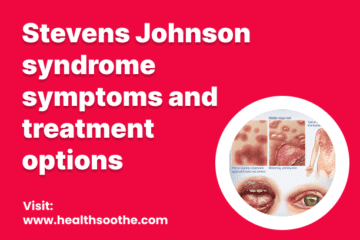 Stevens Johnson Syndrome Symptoms And Treatment Options