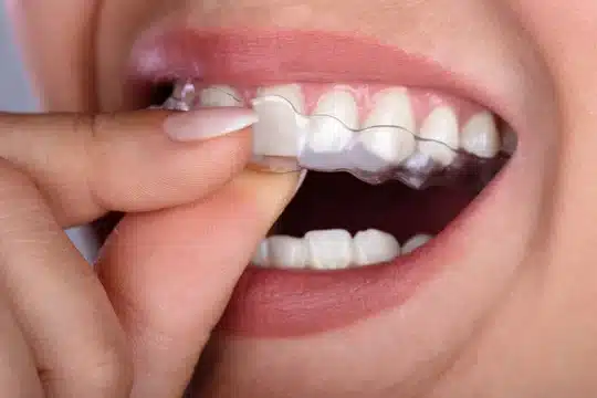 What Are Teeth Aligners' Prices In India?