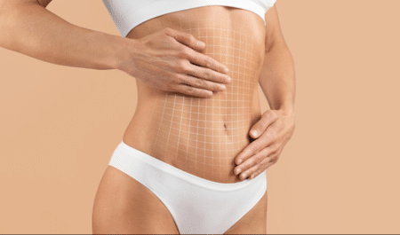 What Is The Ideal Weight For A Tummy Tuck?