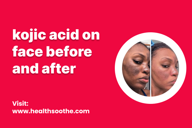 Kojic Acid On Face Before And After
