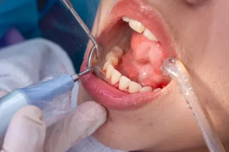 Improving Dental Precision With High-Quality Carbide Burs