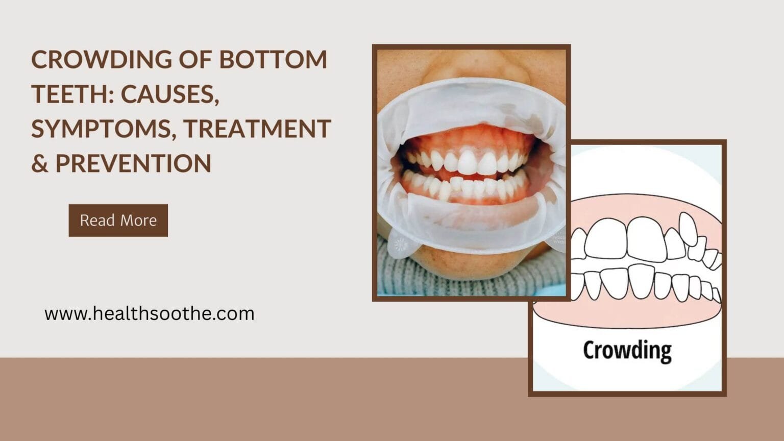 Crowding of Bottom Teeth: Causes, Symptoms, Treatment & Prevention crowding of bottom teeth