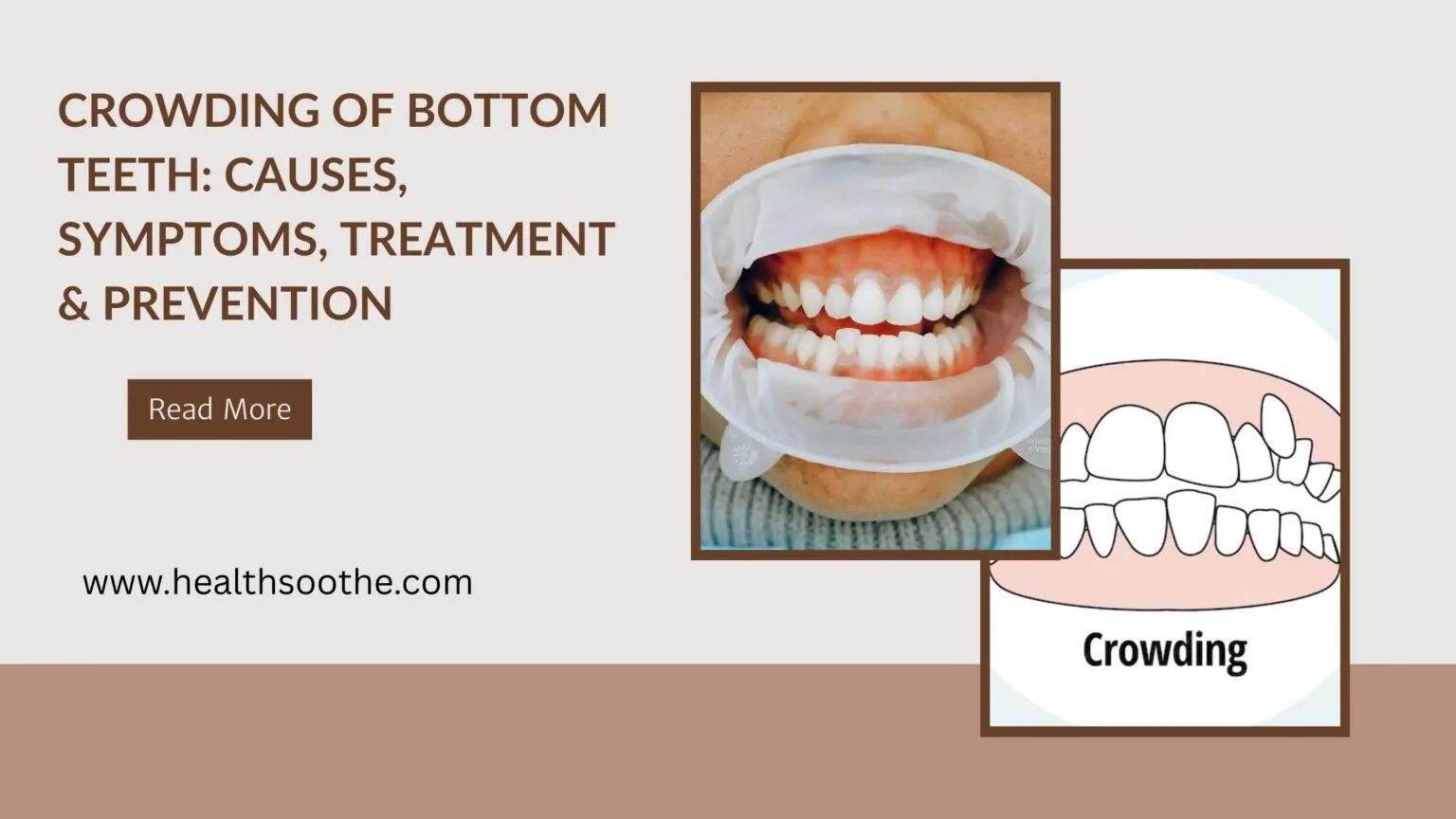 Crowding of Bottom Teeth: Causes, Symptoms, Treatment & Prevention crowding of bottom teeth