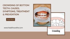crowding of bottom teeth