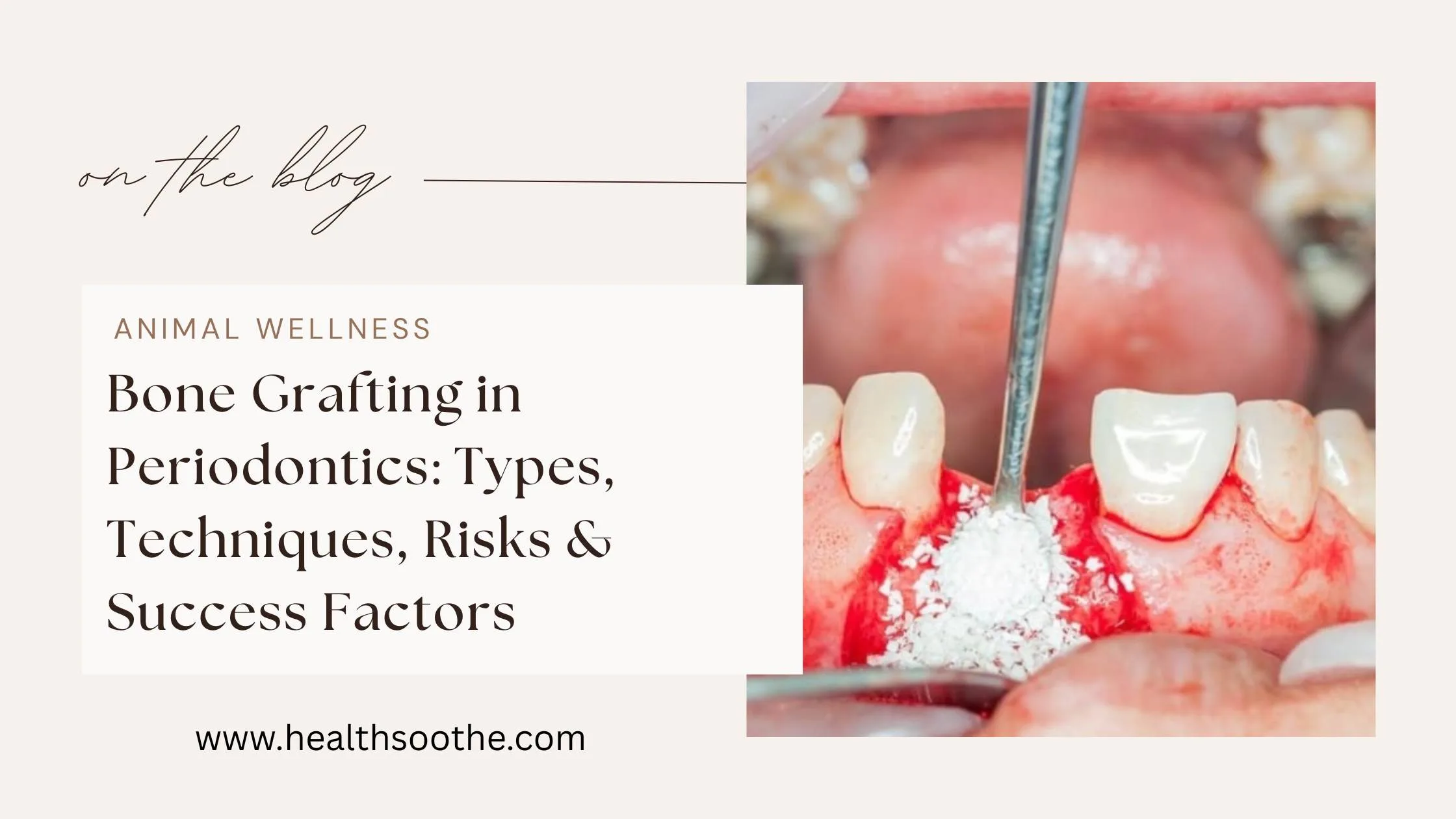 Healthsoothe 1 Bone Graft