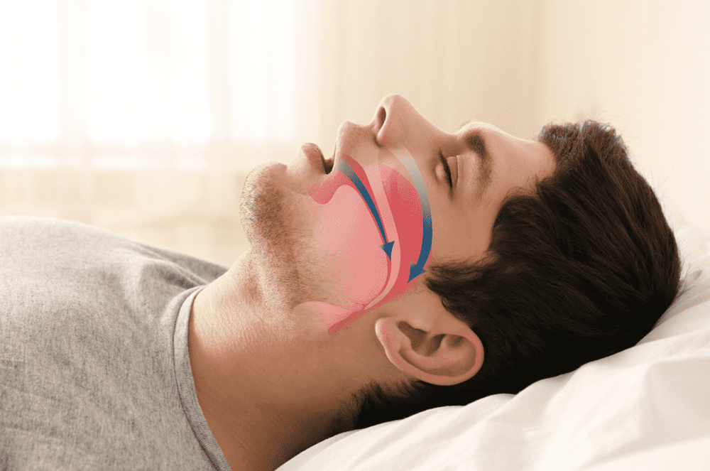 What Is Obstructive Sleep Apnea And How Serious Can It Be? 3 1784324