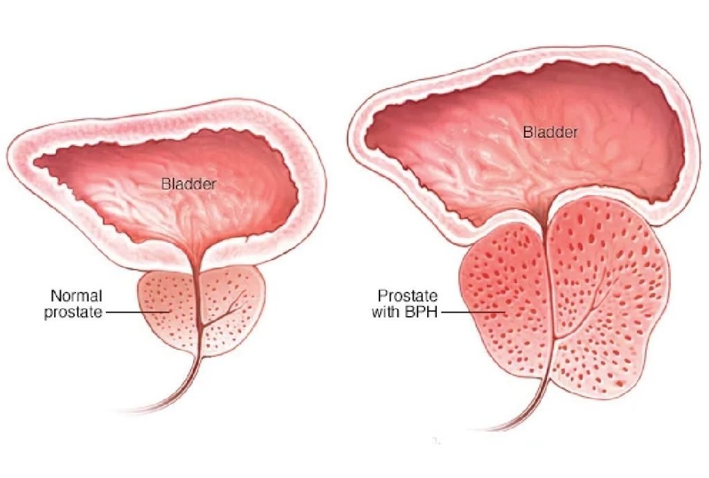 Preventing Bph Progression: Expert Advice For Singapore Men