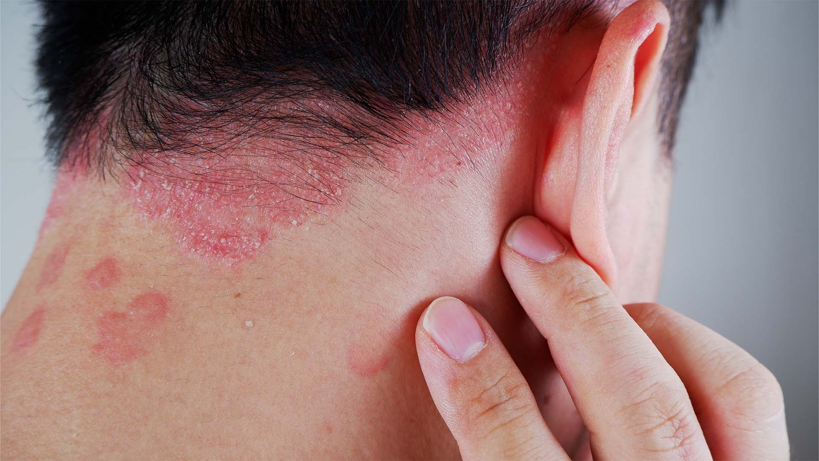 Treatments Doctors Use To Manage Psoriasis 4 Psoriasis Article