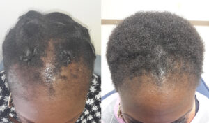 female hair transplant patient before after 6 2