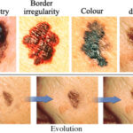 ABCDE Rule for Melanoma: A Complete Guide to the Skin Self-Exam 1 ch9991258