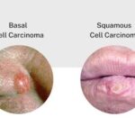 Basal Cell Carcinoma vs. Squamous Cell Carcinoma: Key Differences 3 images 10