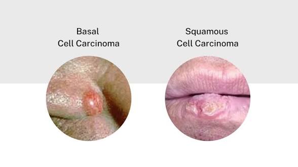 Basal Cell Carcinoma vs. Squamous Cell Carcinoma: Key Differences 1 images 10