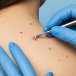 What Happens During a Skin Biopsy? Step-by-Step Guide 2 images 11