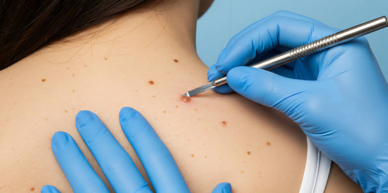 What Happens During a Skin Biopsy? Step-by-Step Guide